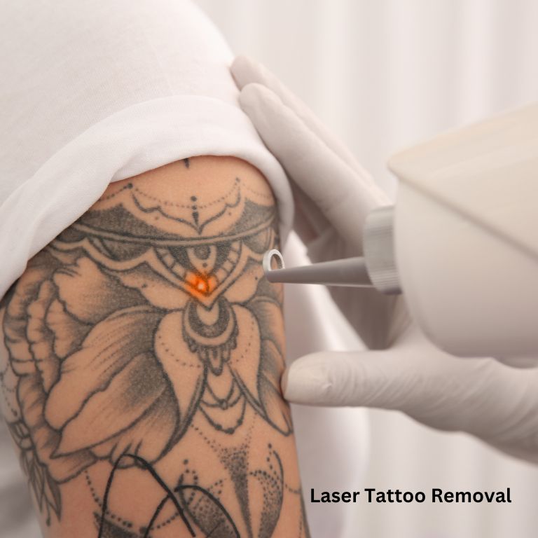 Laser Tattoo Removal